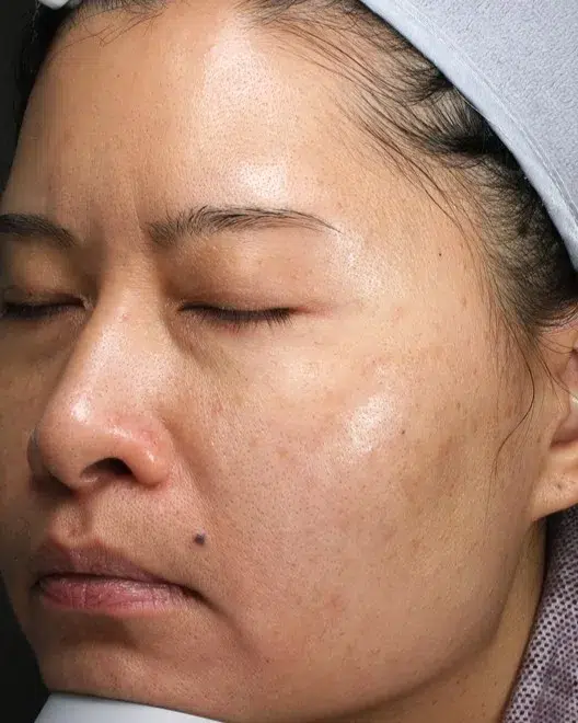 Melanocytic nevi · After · Case 42 · Luowei Medical Aesthetics Clinic