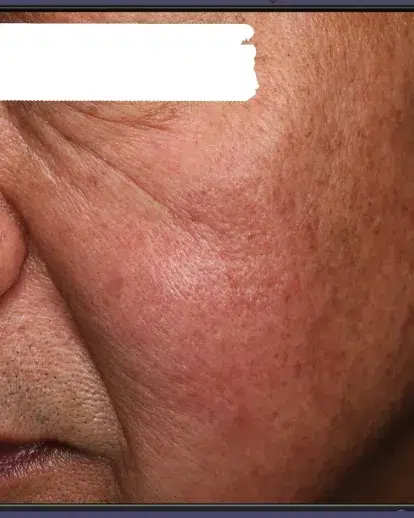 Hyperpigmentation After · Case 43 · Luowei Medical Aesthetics Clinic