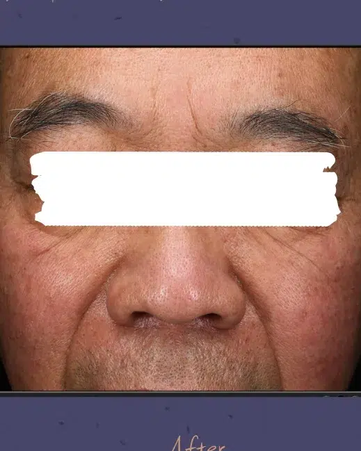 Age Spots / Sun Spots — After Treatment · Case 36 · Luowei Medical Aesthetics Clinic