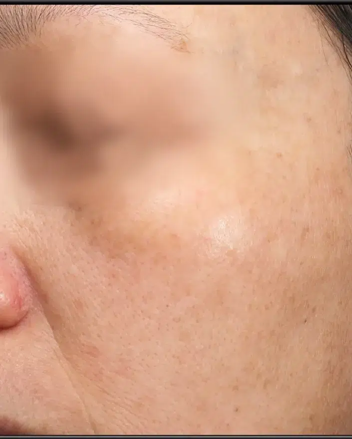 Treating Age Spots / Sun Spots — After · Case 37 · Luowei Medical Aesthetics Clinic
