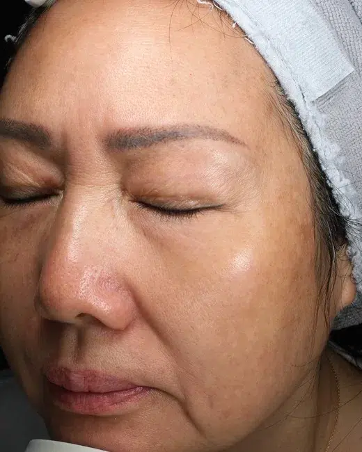 Hyperpigmentation After · Case 46 · Luowei Medical Aesthetics Clinic