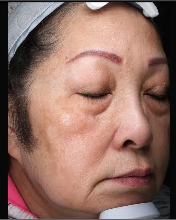 Sun Damage / Photoaging After-Treatment · Case 48 · Luowei Medical Aesthetics Clinic