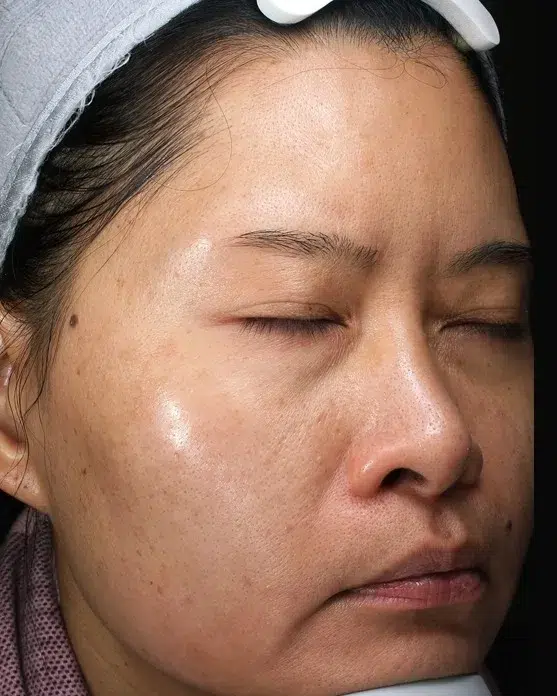 Pigmentation post-treatment · Case 49 · Luowei Medical Aesthetics Clinic