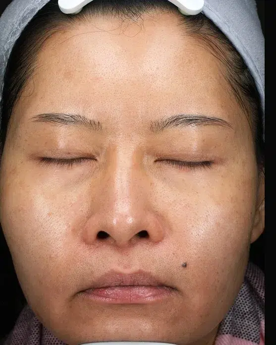 Treating age spots / sun spots — After · Case 40 · Luowei Medical Aesthetics Clinic