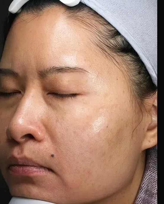 Age Spots / Sun Spots — After Treatment · Case 63 · Luowei Medical Aesthetics Clinic