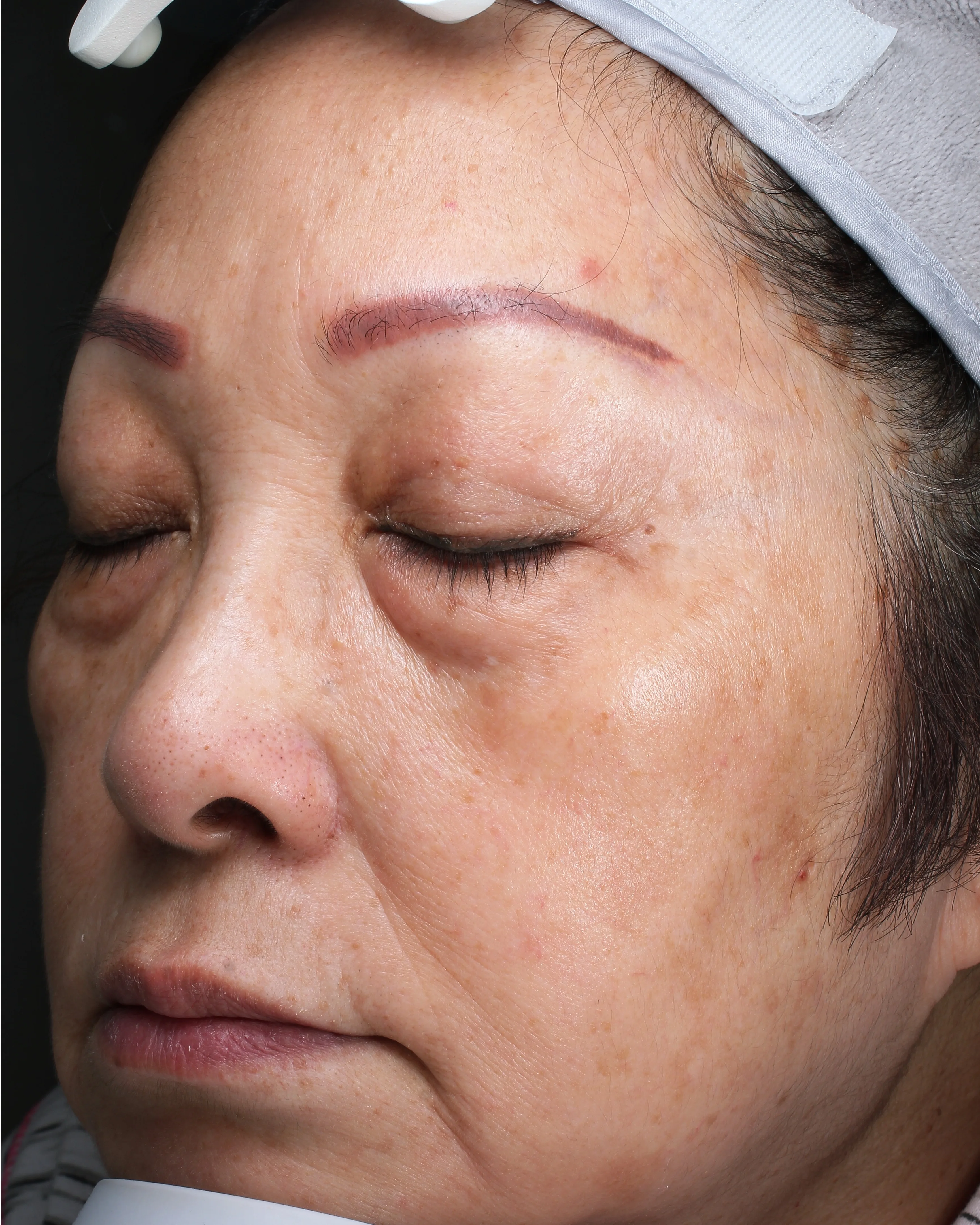 Sun Damage / Photoaging after · Case 54 · Luowei Medical Aesthetics Clinic