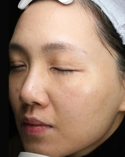 Pigmentation After · Case 71 · Luowei Medical Aesthetics Clinic