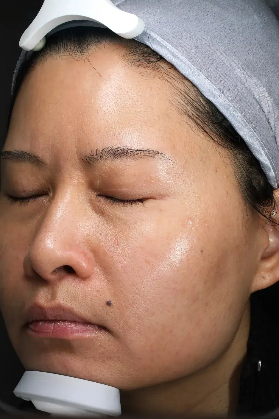 Sun Damage / Photoaging After · Case 76 · Luowei Medical Aesthetics Clinic