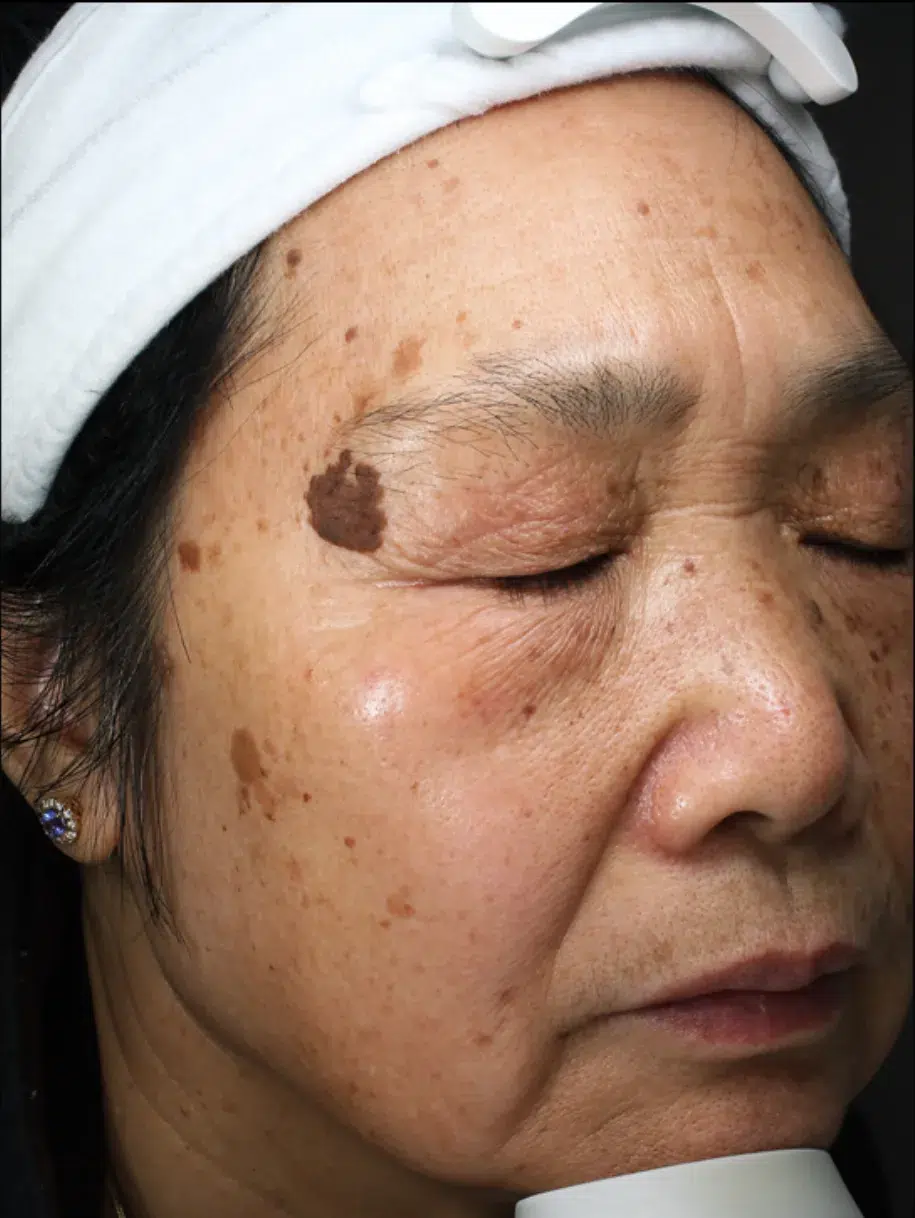 Treating Age Spots / Sun Spots — Before · Case 3 · Luowei Medical Aesthetics Clinic