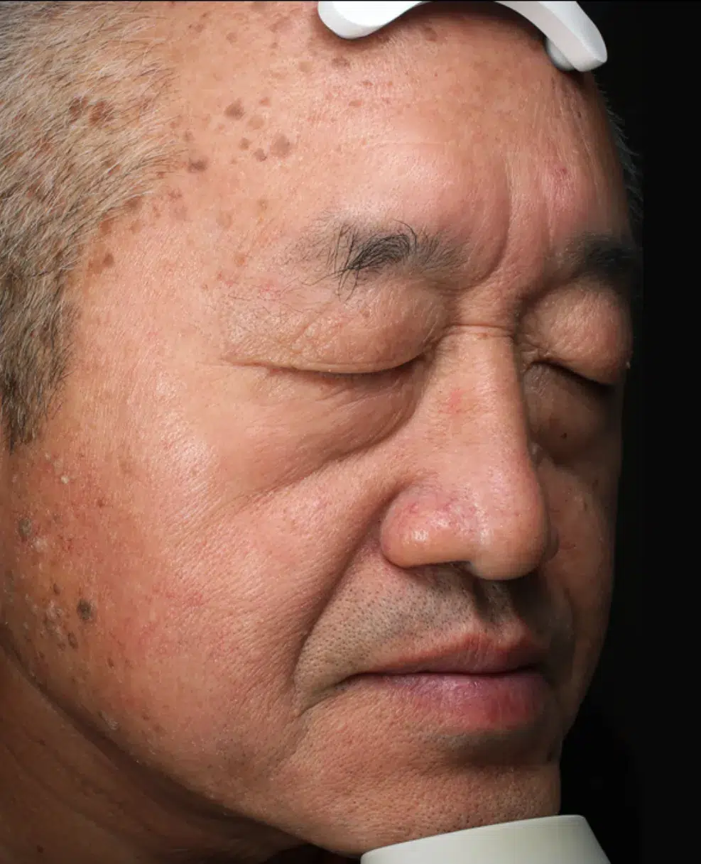 Age Spots / Sun Spots Treatment Before · Case 4 · Luowei Medical Aesthetics Clinic