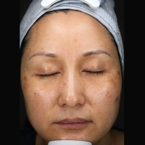 Age Spots / Sunspots Before Treatment · Case 04 · Luowei Medical Aesthetics Clinic