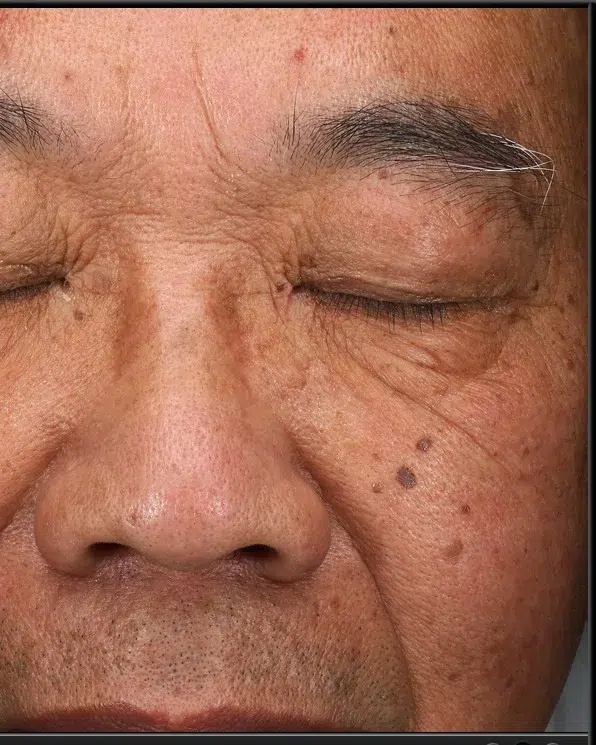 Hyperpigmentation Before · Case 38 · Luowei Medical Aesthetics Clinic