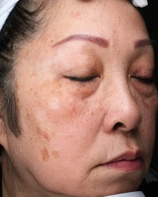 Age Spots / Sun Spots — Before Treatment · Case 31 · Luowei Medical Aesthetics Clinic