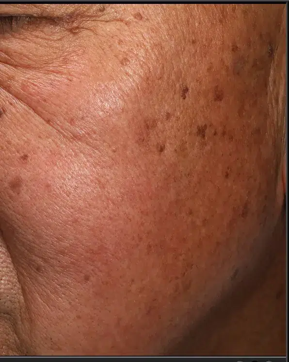 Hyperpigmentation Before · Case 40 · Luowei Medical Aesthetics Clinic