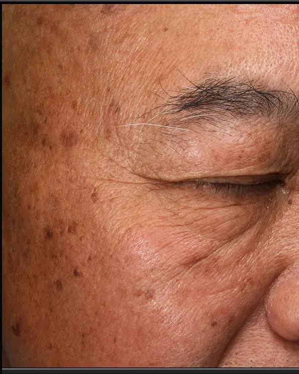 Pigmentation pre-treatment · Case 41 · Luowei Medical Aesthetics Clinic