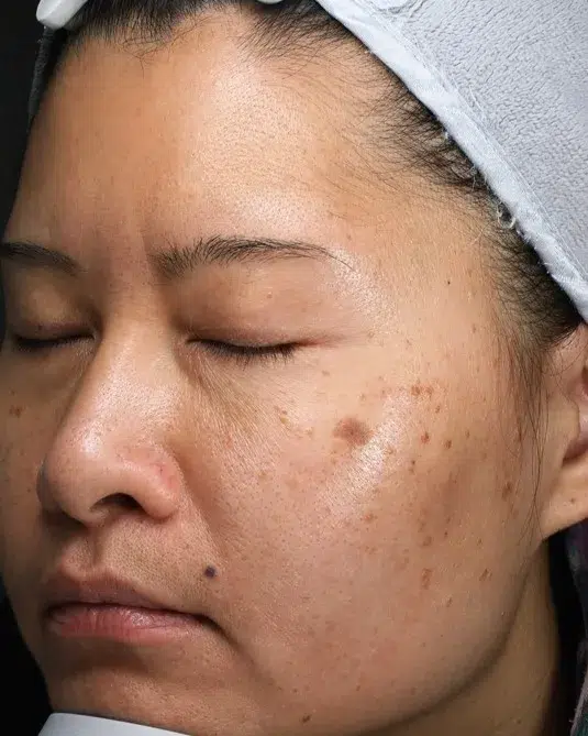 Pigmented Nevus · Before · Case 42 · Luowei Medical Aesthetics Clinic