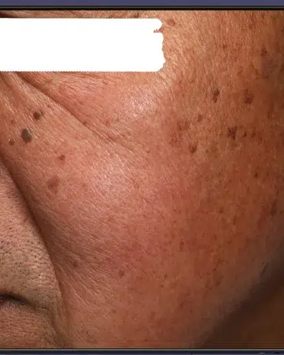 Pigmentation Before · Case 43 · Luowei Medical Aesthetics Clinic