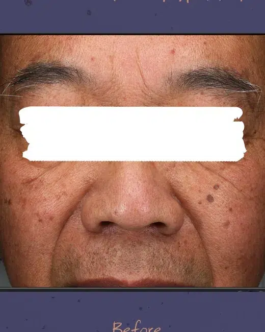 Treating age spots / sun spots — Before · Case 36 · Luowei Medical Aesthetics Clinic