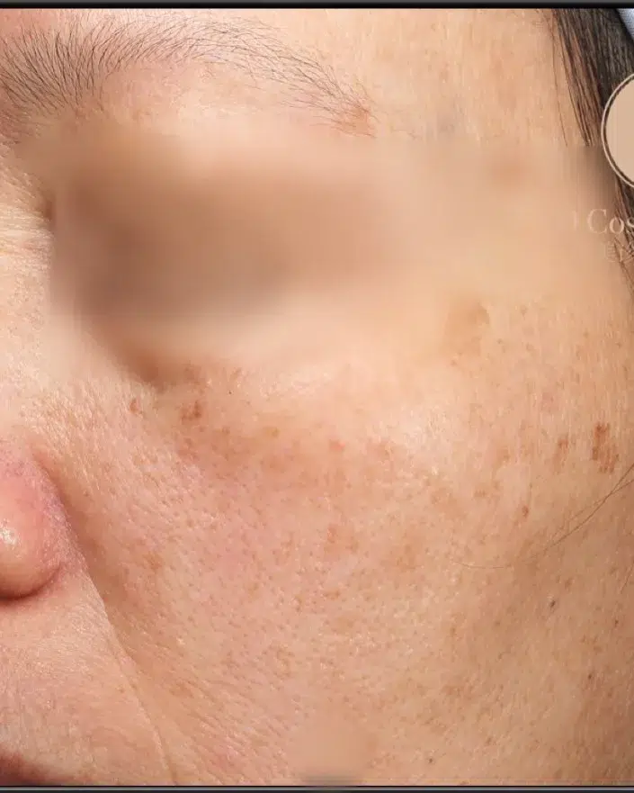 Age Spots / Sun Spots — Before Treatment · Case 37 · Luowei Medical Aesthetics Clinic