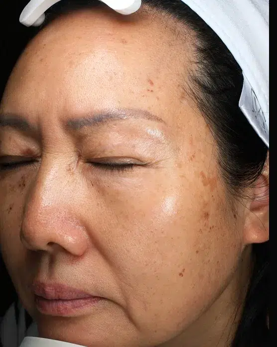 Hyperpigmentation Before · Case 46 · Luowei Medical Aesthetics Clinic