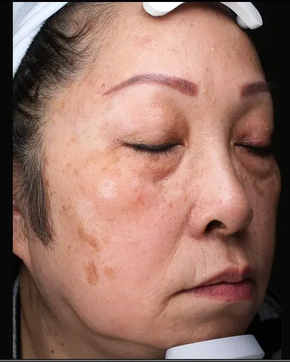 Sun Damage / Photoaging Before-Treatment · Case 48 · Luowei Medical Aesthetics Clinic