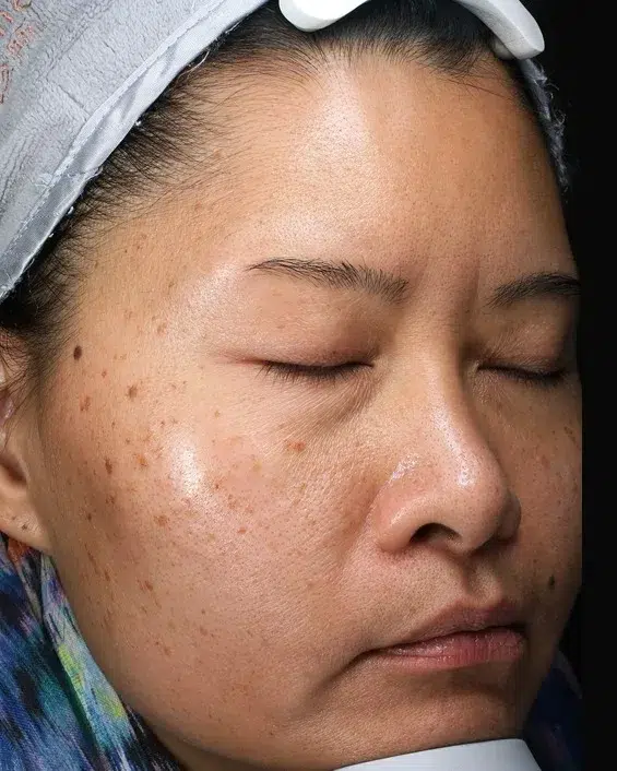 Hyperpigmentation Before · Case 49 · Luowei Medical Aesthetics Clinic