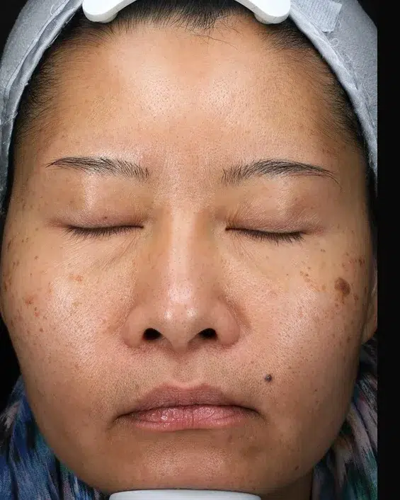 Treating Age Spots / Sun Spots — Before Treatment · Case 40 · Luowei Medical Aesthetics Clinic
