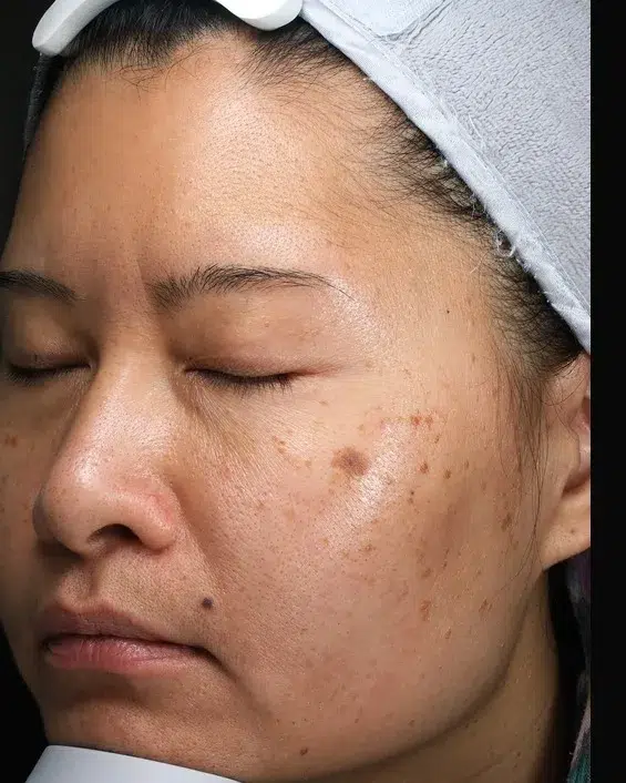 Age Spots / Sun Spots — Before · Case 63 · Luowei Medical Aesthetics Clinic
