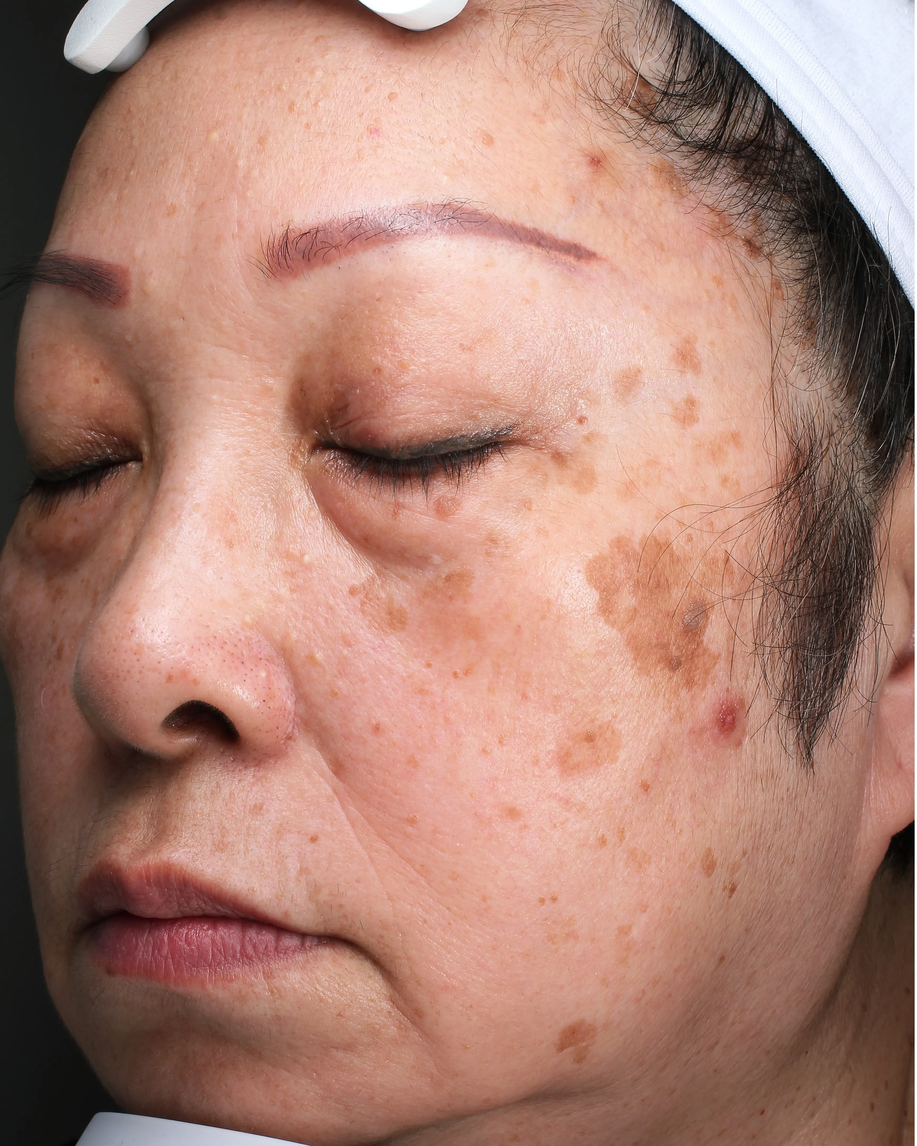Sun Damage / Photoaging before · Case 54 · Luowei Medical Aesthetics Clinic