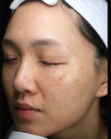 Pigmentation pre-treatment · Case 71 · Luowei Medical Aesthetics Clinic