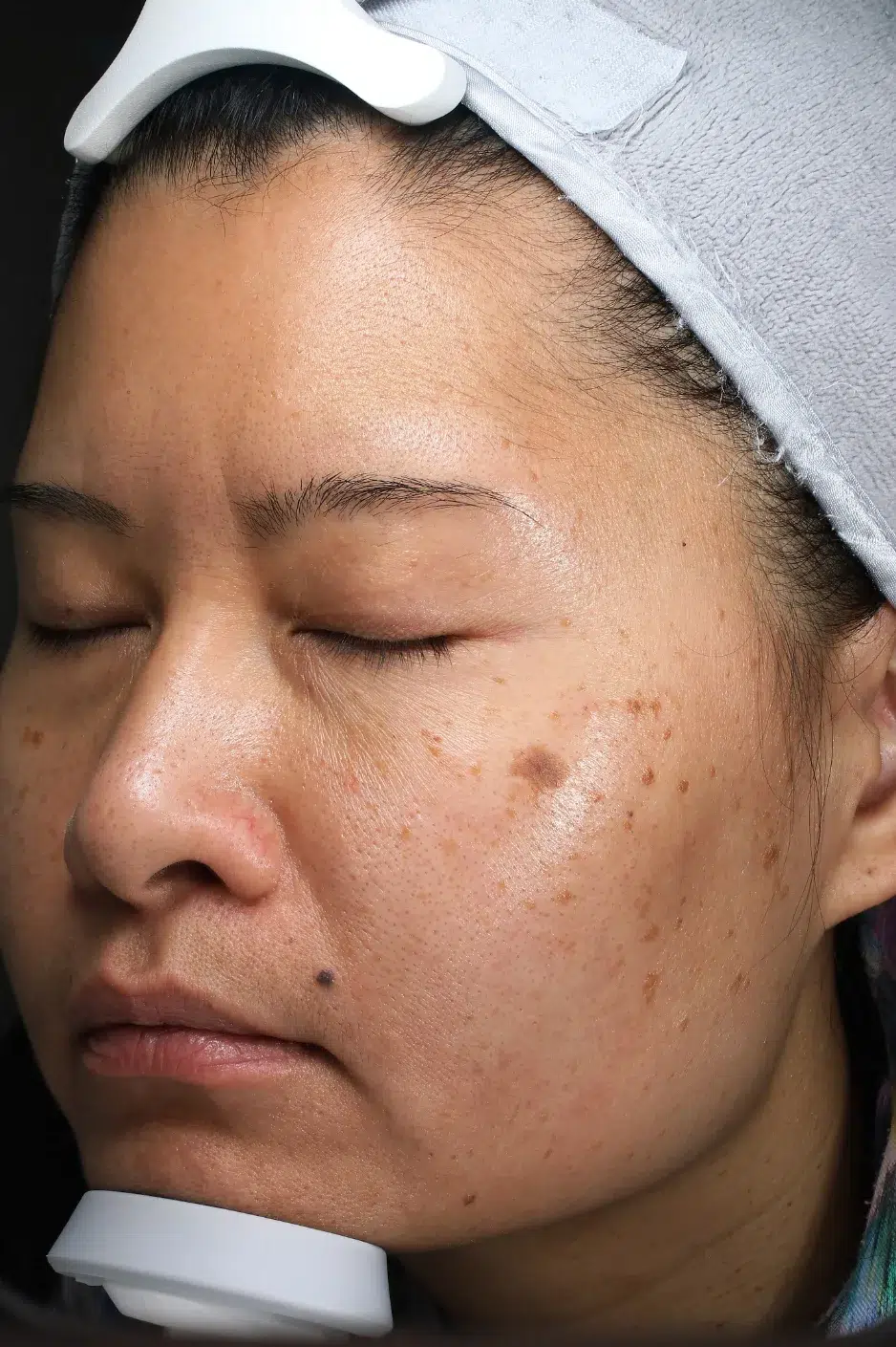 Sun Damage / Photoaging Before · Case 76 · Luowei Medical Aesthetics Clinic