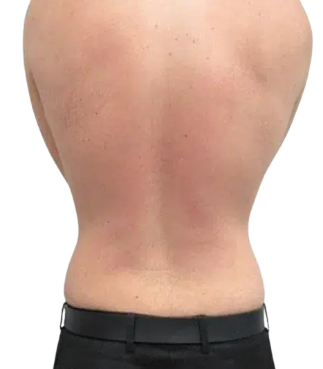 BTL ExilisLocalized Fat Reduction Results · RF + Ultrasound Body Contouring · Luowei Medical Aesthetics Clinic Nanjing · Case 05