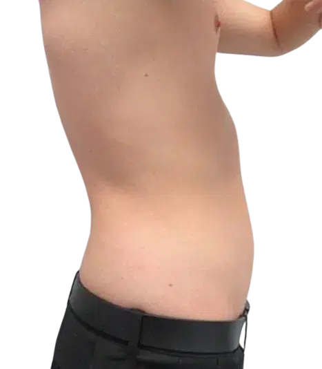 Weight Gain & Body Fat — After · Case 5 · Luowei Medical Aesthetics Clinic