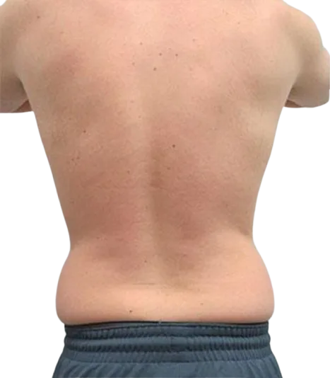 BTL ExilisLocalized Fat Reduction Before & After · RF + Ultrasound Body Contouring · Luowei Medical Aesthetics Clinic Nanjing · Case 05