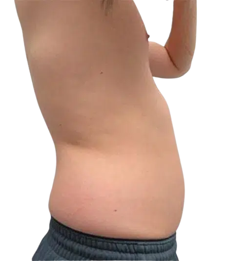 Weight Gain & Body Fat — Before · Case 5 · Luowei Medical Aesthetics Clinic