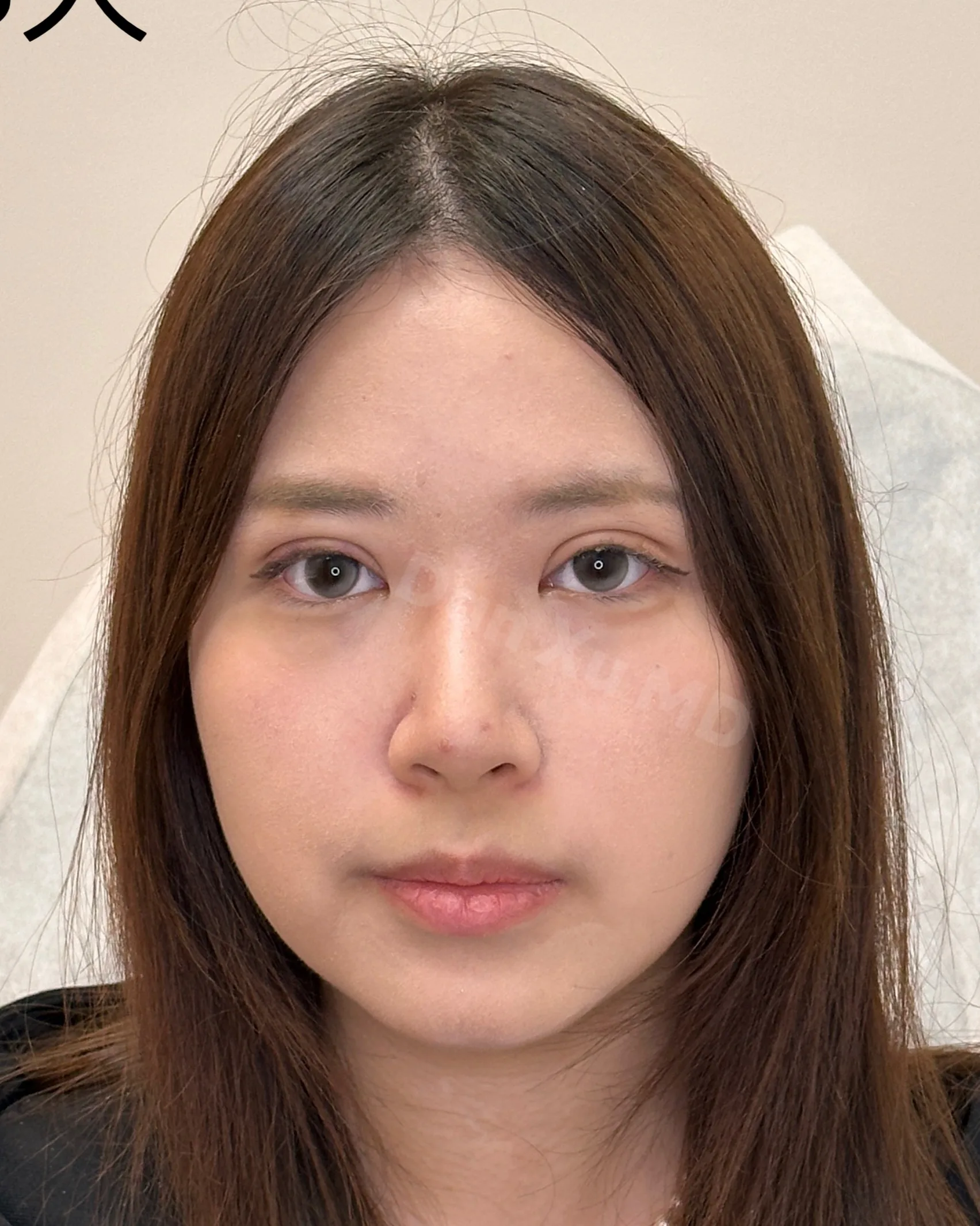Upper Eyelid Ptosis — After · Case 06 · Luowei Medical Aesthetics Clinic