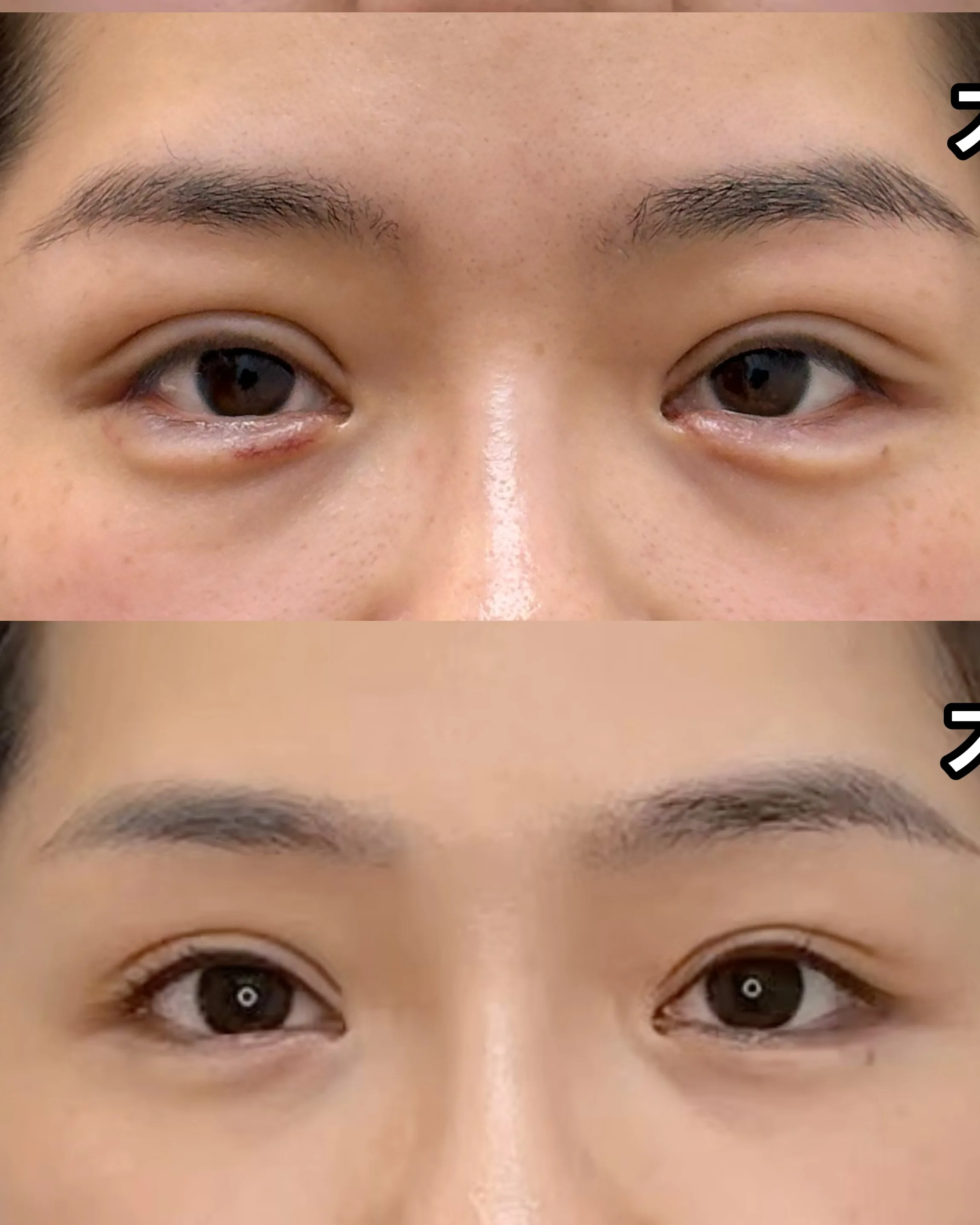 Upper eyelid ptosis — after treatment · Case 08 · Luowei Medical Aesthetics Clinic