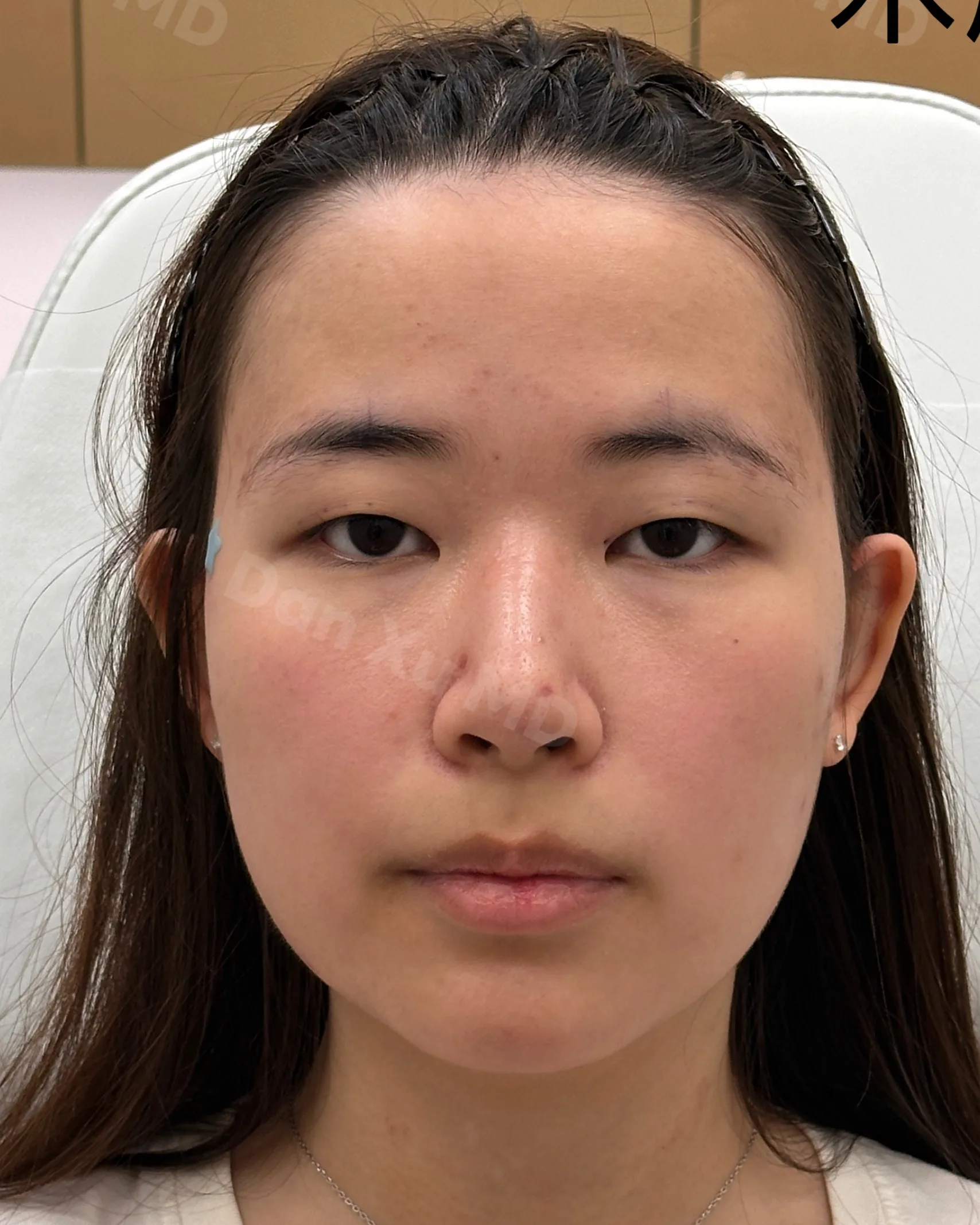 Upper Eyelid Ptosis — Before · Case 06 · Luowei Medical Aesthetics Clinic