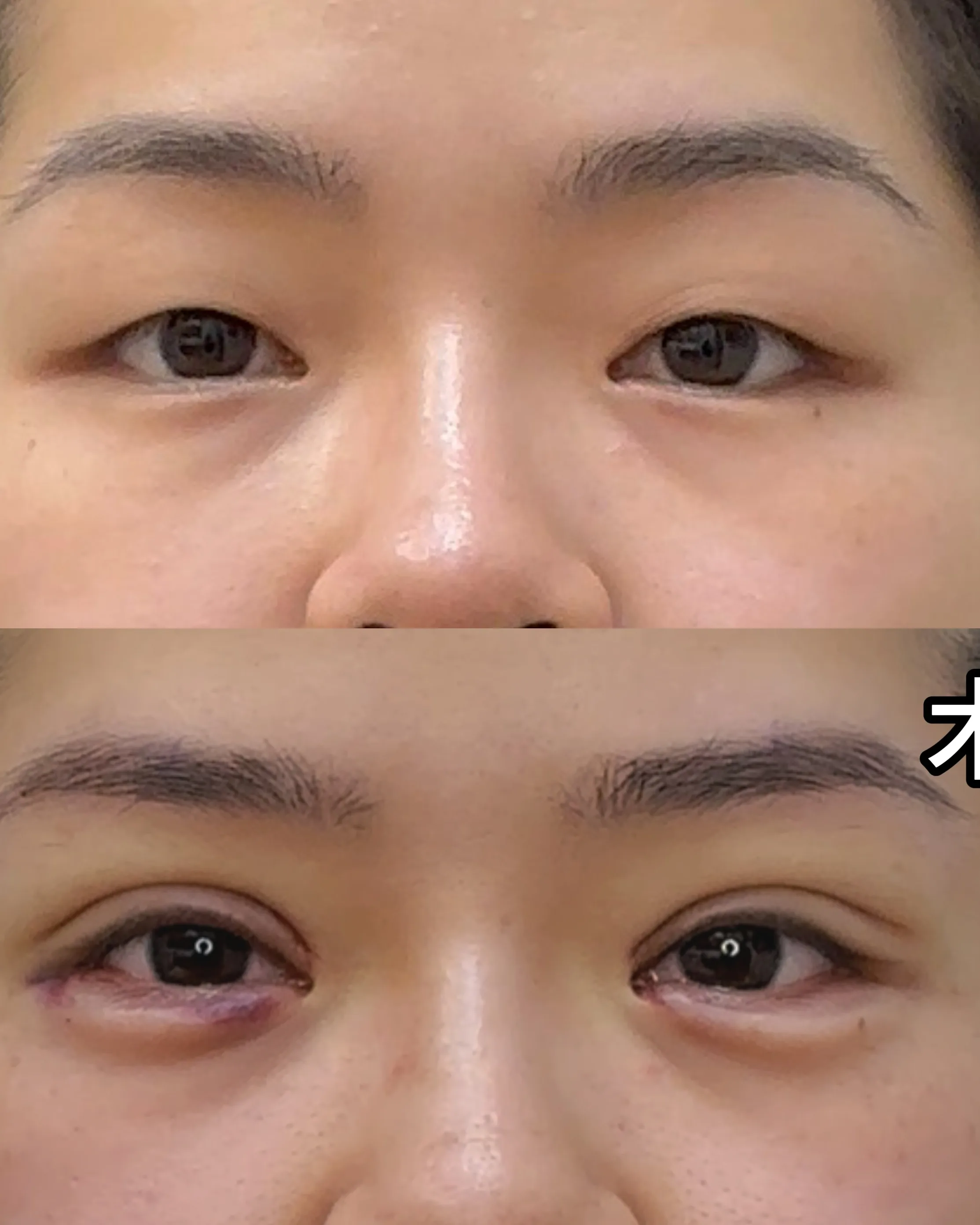 Upper eyelid ptosis — before treatment · Case 08 · Luowei Medical Aesthetics Clinic