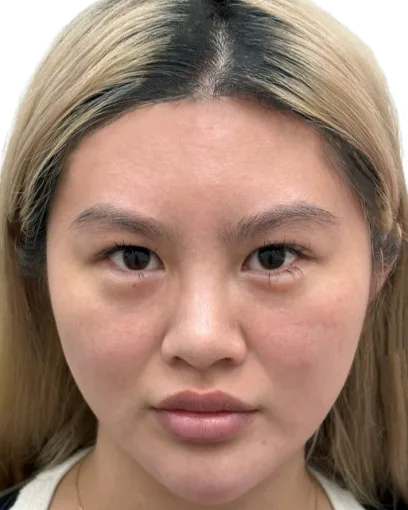 Sensitivity Redness — After Treatment · Case 02 · Luowei Medical Aesthetics Clinic