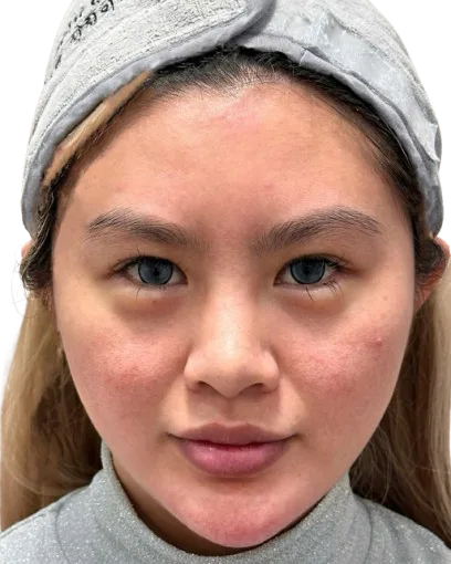 Reactive Redness — Before Treatment · Case 02 · Luowei Medical Aesthetics Clinic