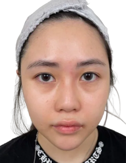 Chubby Cheeks / Facial Fullness — After Treatment · Case 01 · Luowei Medical Aesthetics Clinic