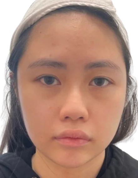Chubby Cheeks / Facial Fullness — Before Treatment · Case 01 · Luowei Medical Aesthetics Clinic