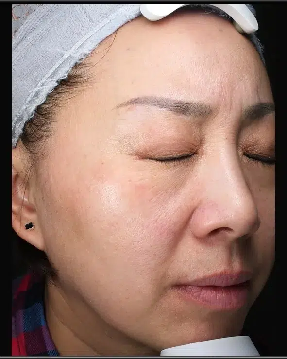 Pigmented Lesion Treatment After · Case 6 · Luowei Medical Aesthetics Clinic