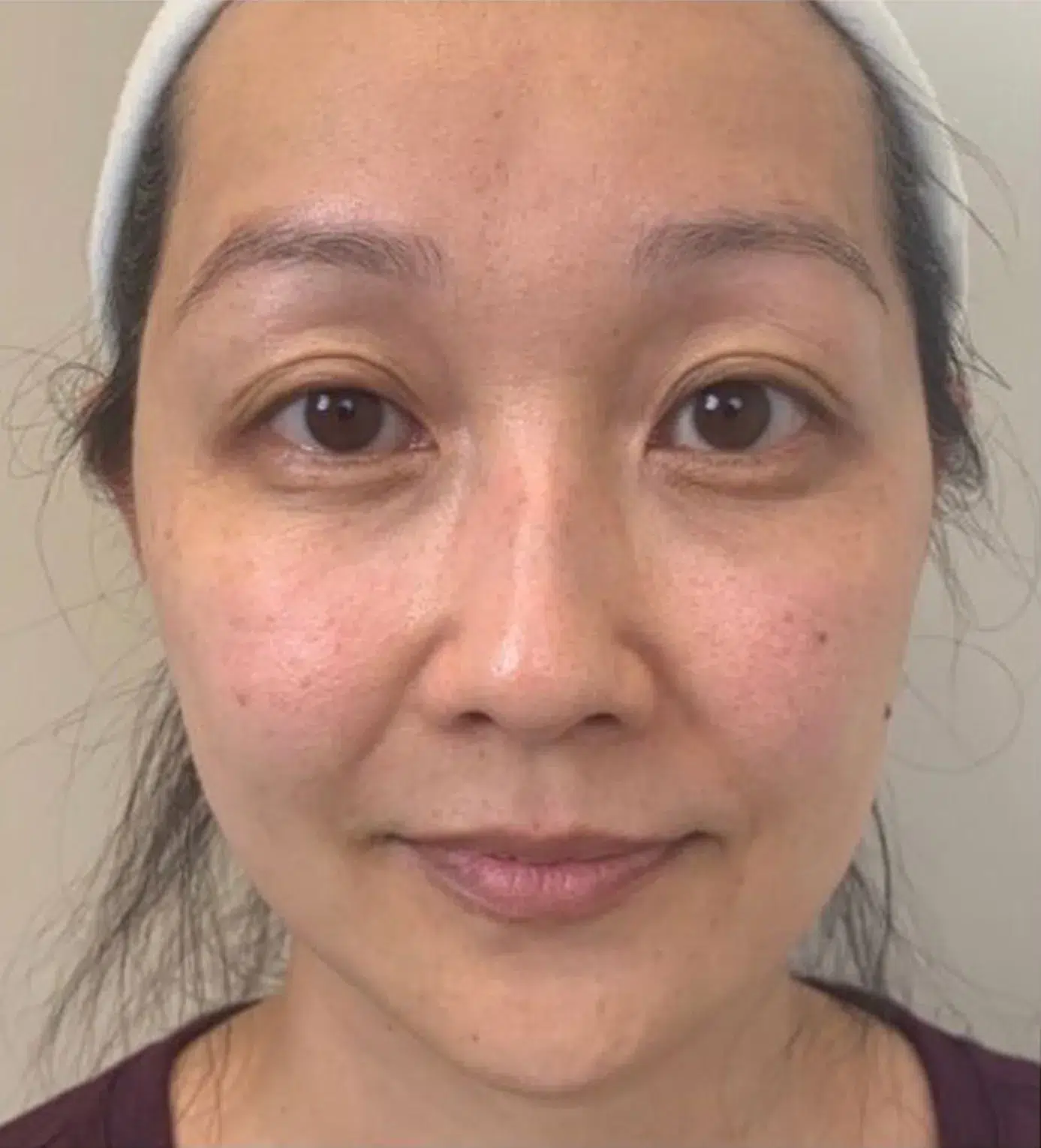 Pigmentation post-treatment · Case 07 · Luowei Medical Aesthetics Clinic