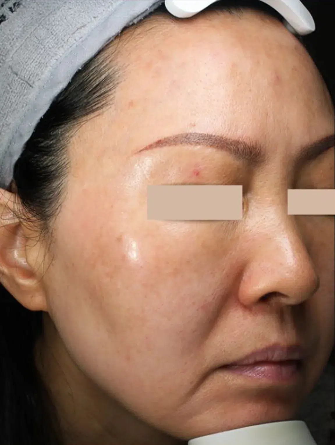 Pigmentation After · Case 08 · Luowei Medical Aesthetics Clinic