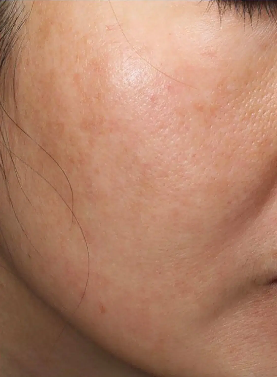 Hyperpigmentation After · Case 09 · Luowei Medical Aesthetics Clinic