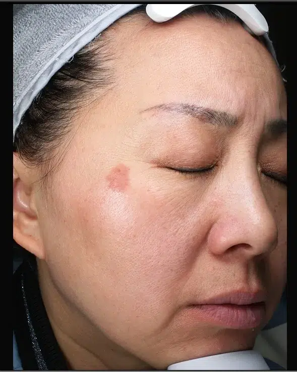 Treating Pigmented Lesions — Before · Case 6 · Luowei Medical Aesthetics Clinic