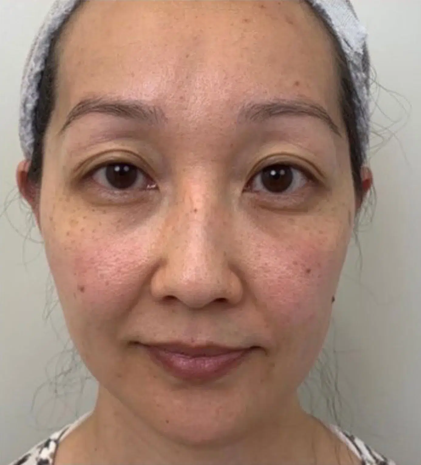 Hyperpigmentation Before · Case 07 · Luowei Medical Aesthetics Clinic