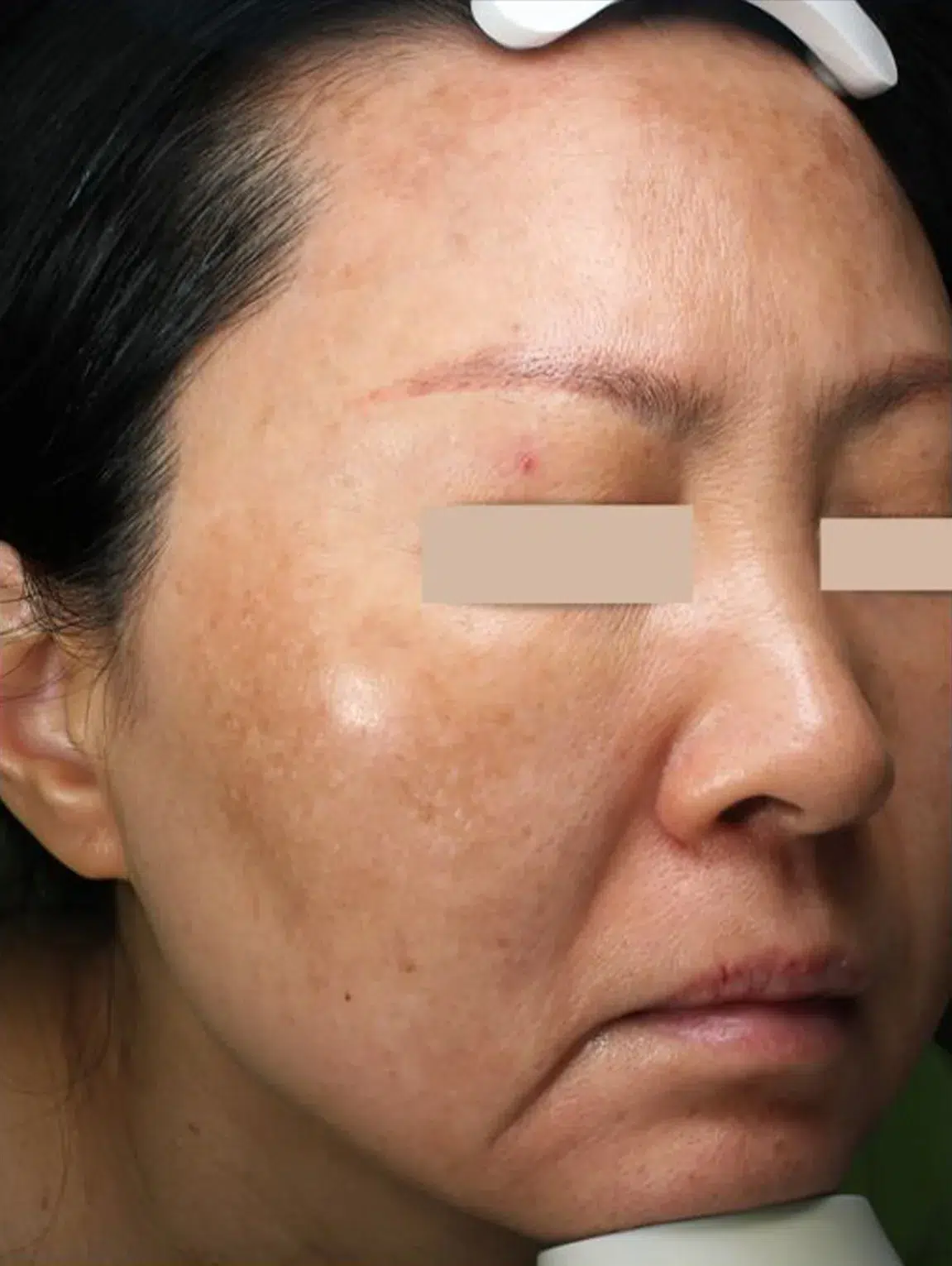 Pigmentation pre-treatment · Case 08 · Luowei Medical Aesthetics Clinic